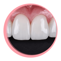 Aftercare and Maintenance for Patients with Porcelain Veneers