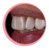 {FAQ} Can Porcelain Veneers Be Whitened?