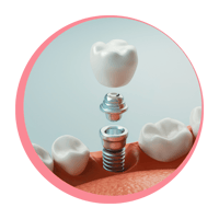 Here’s how full arch dental implants could transform your smile