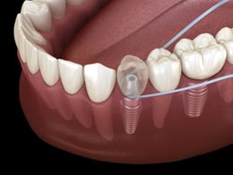 Flossing-around-implant-scaled