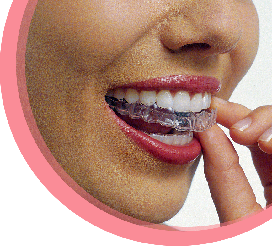A close-up of a woman as she is putting an Invisalign clear aligner onto her top teeth.