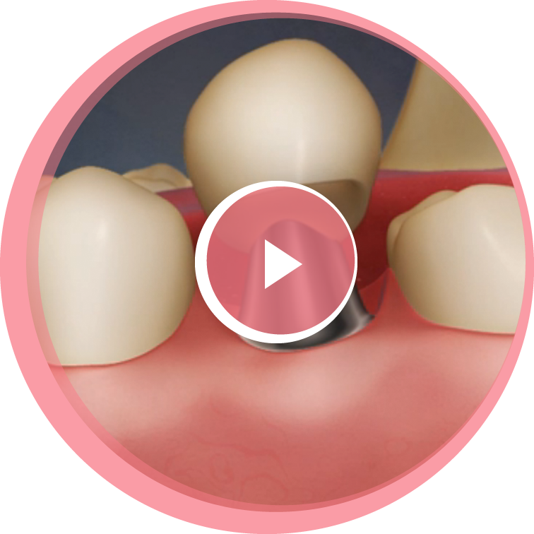 A close-up of a dental implant restoration being fitted into a jaw between two neighboring teeth.