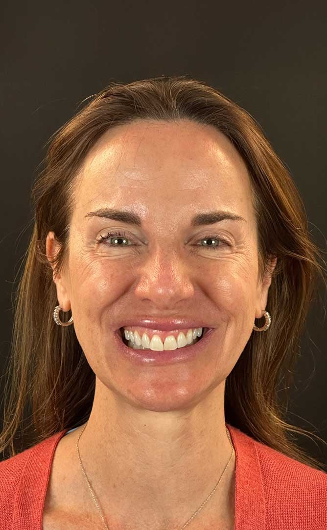 Porcelain Veneers Patient