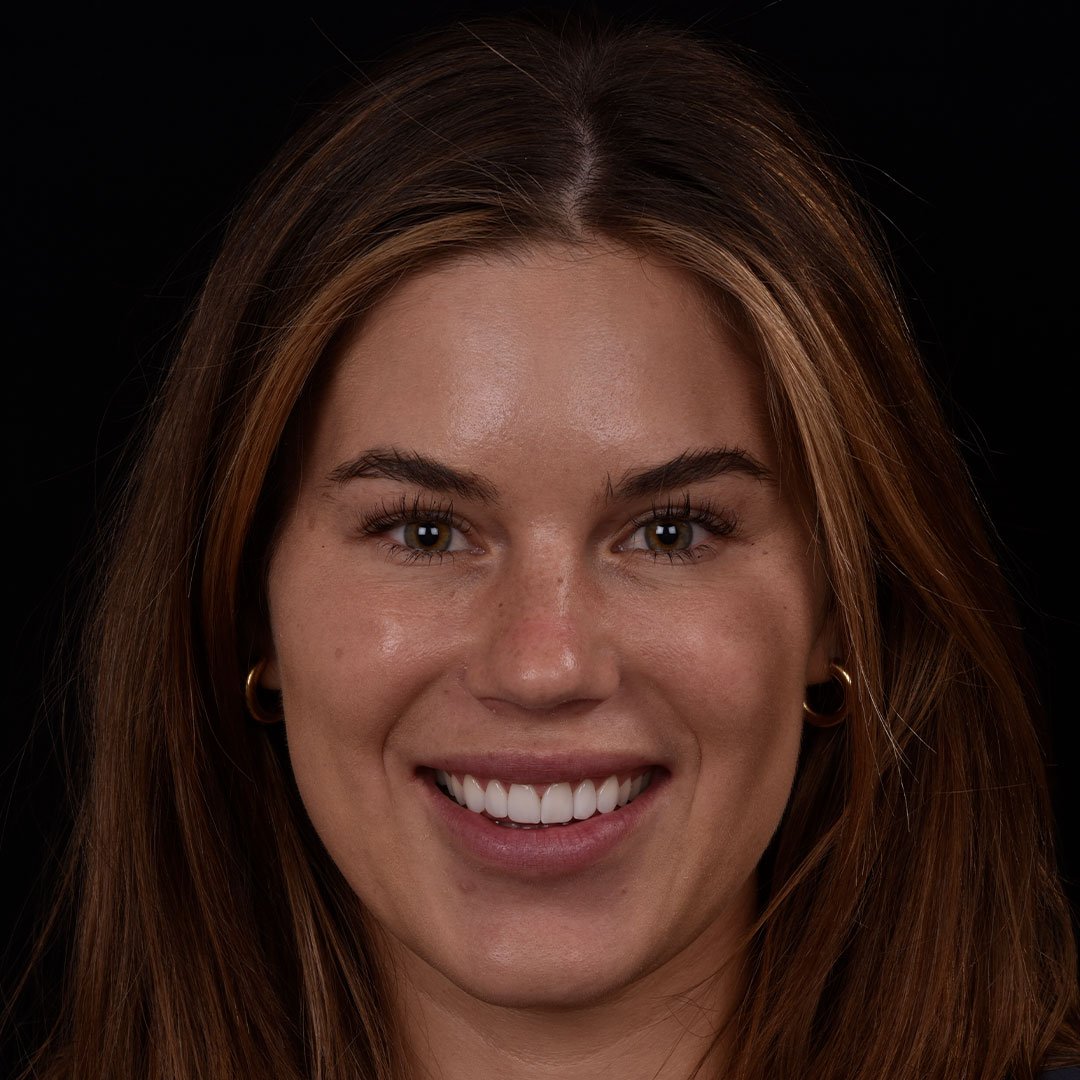 Happy Patient after Smile Makeover Front Profile