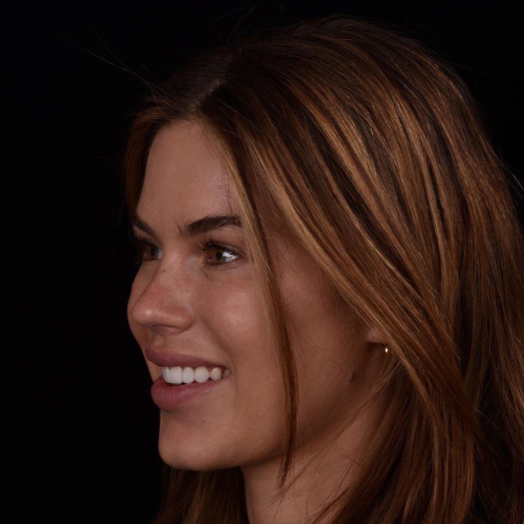 Side Profile of Happy Patient after Smile Makeover