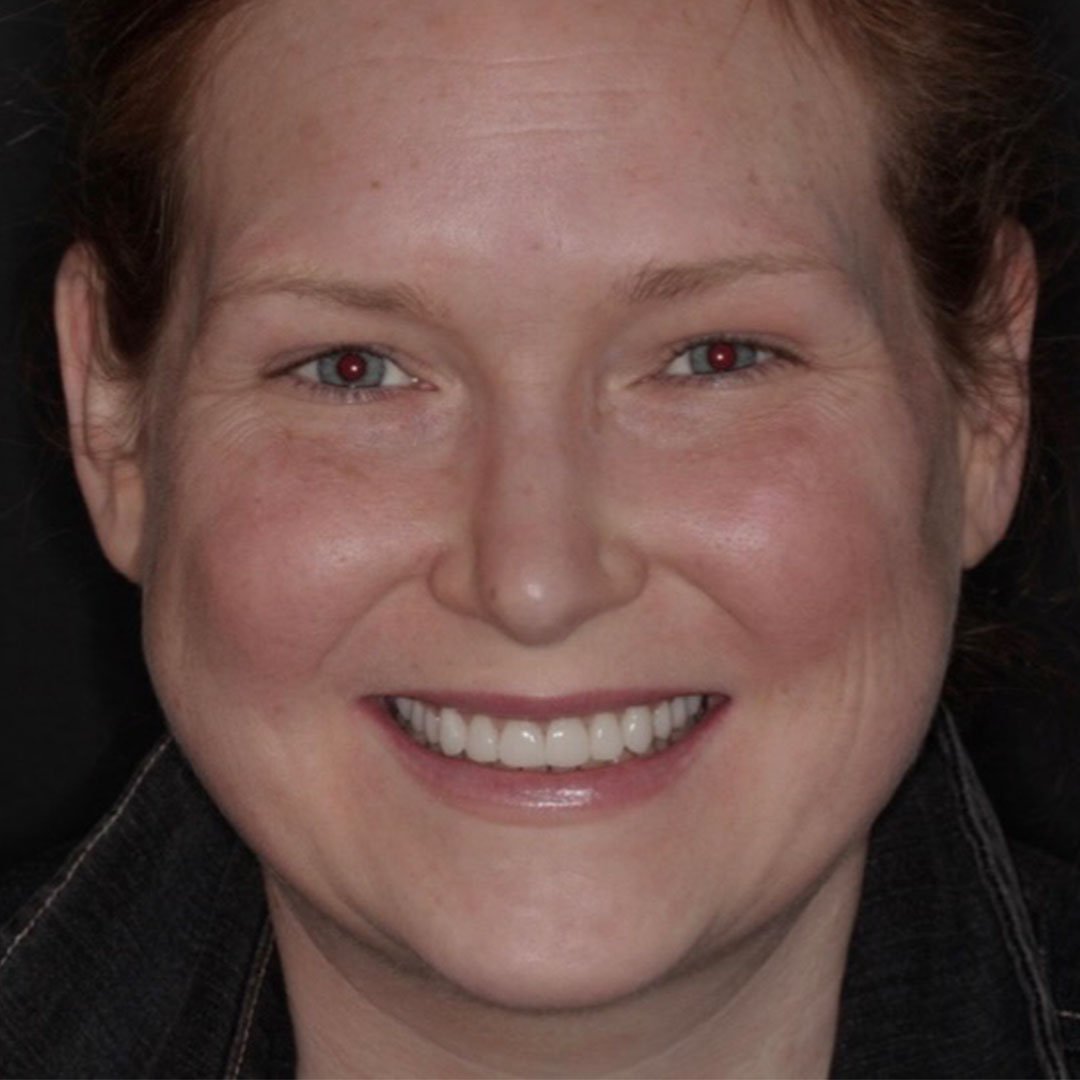 Caroline Smile Transformation Highlights