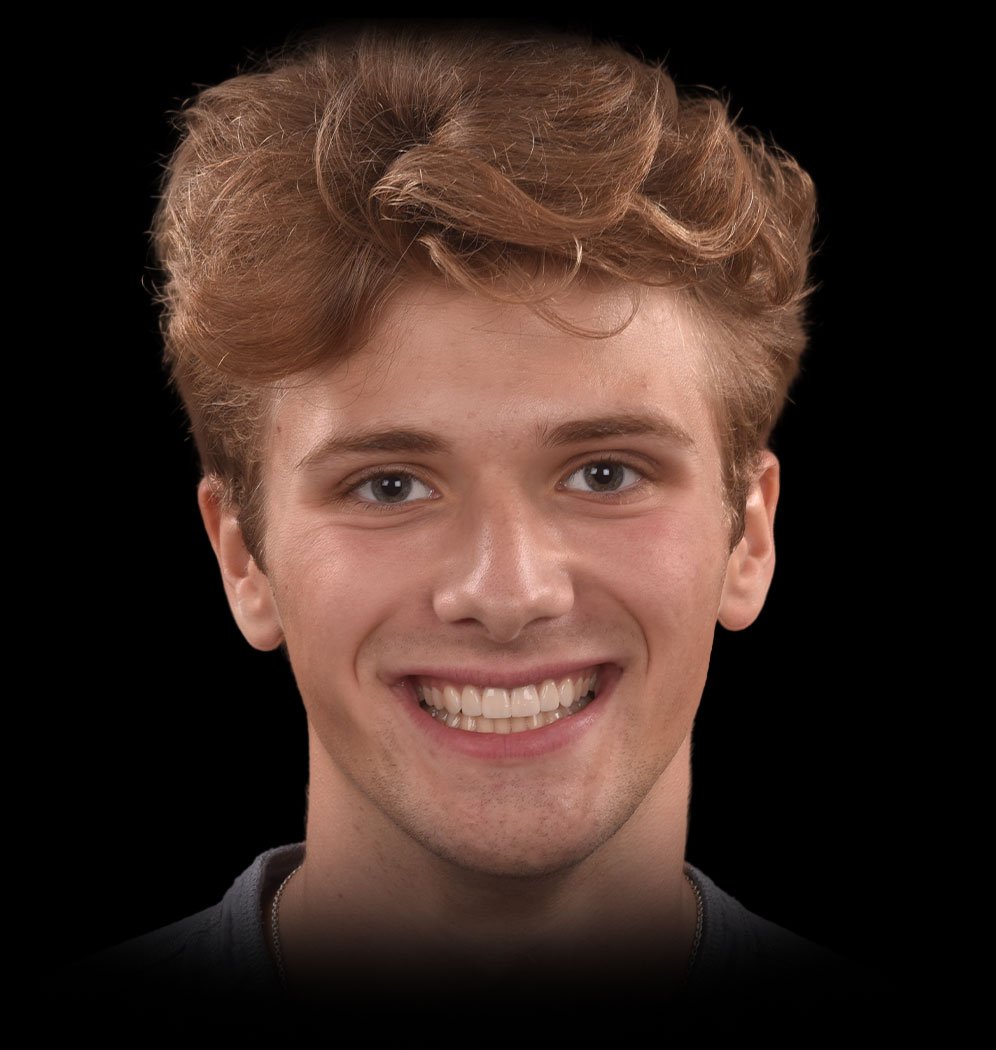 Devan Smile Transformation 