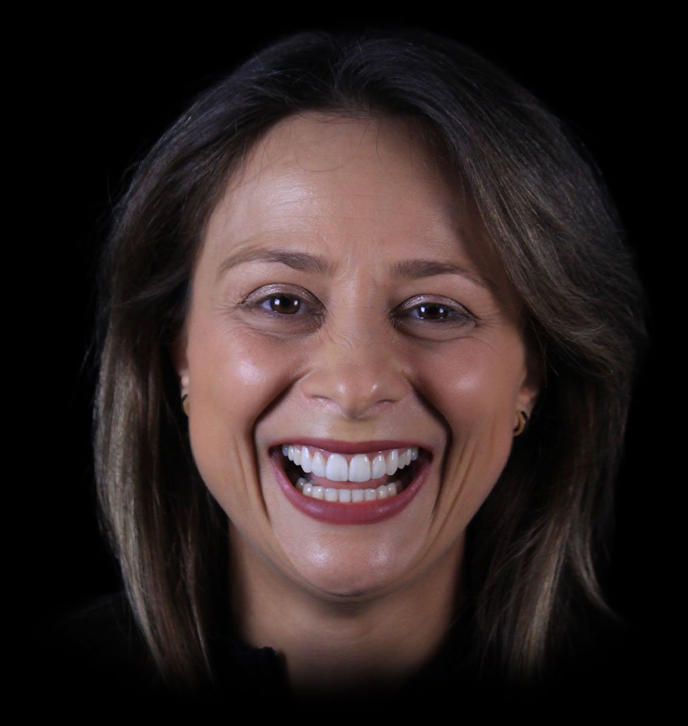 Tugba Smile Transformation