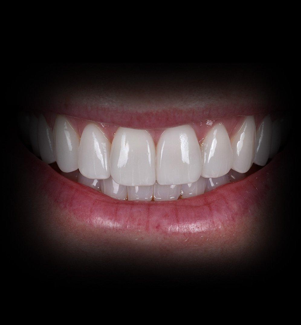 Abbie Smile Transformation Story