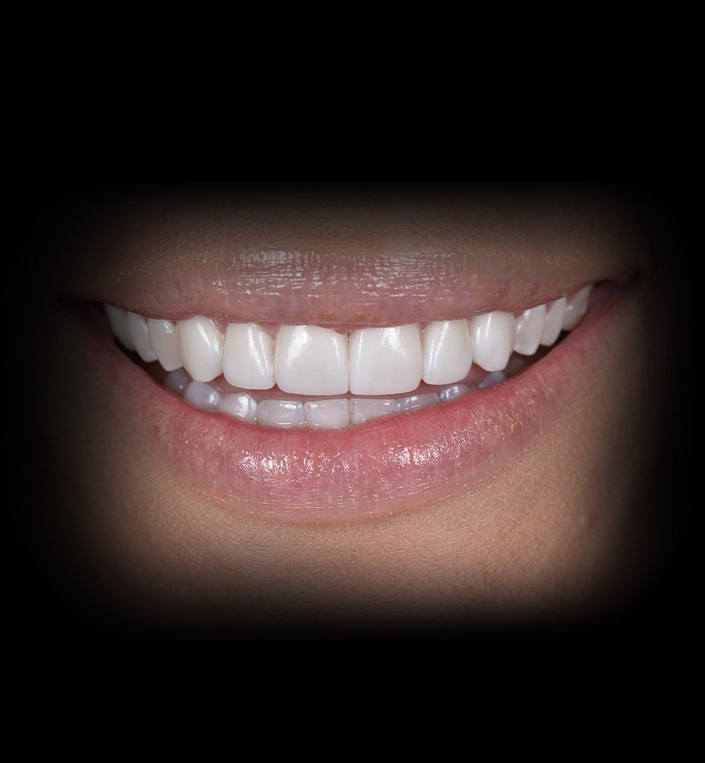 Adriana Smile Transformation Story