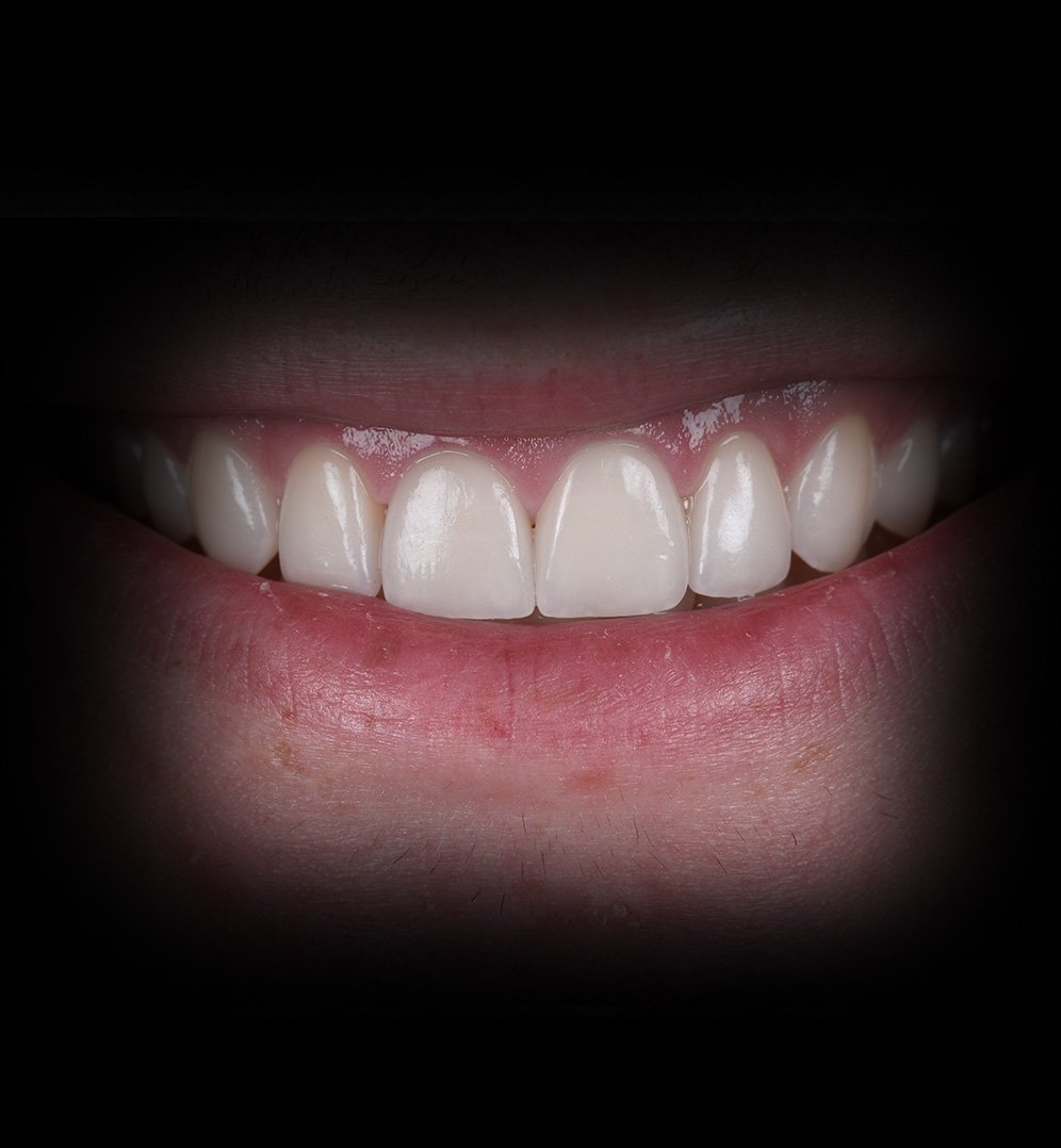 Aiden Smile Transformation Story