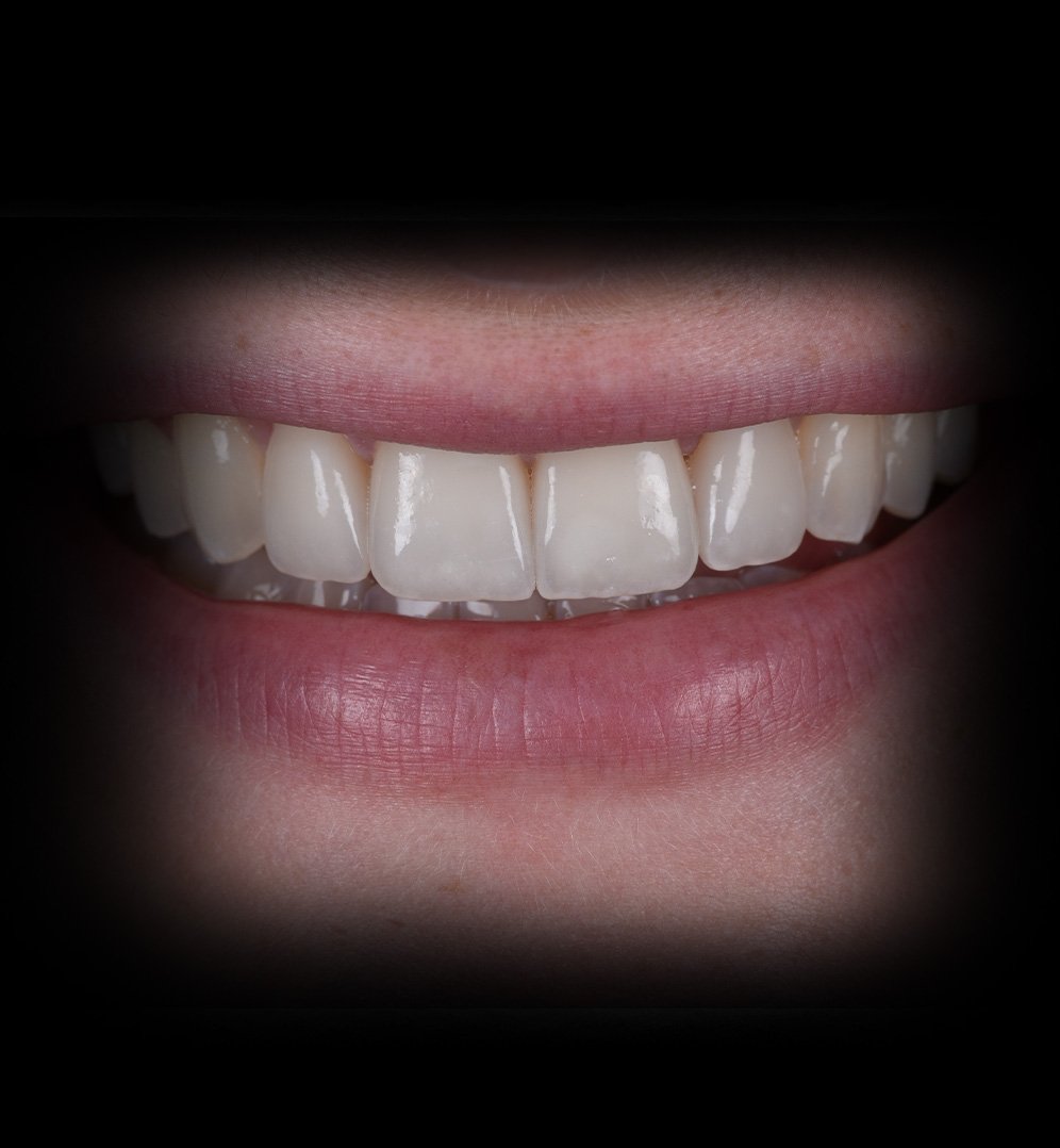 Anoush Smile Transformation Story