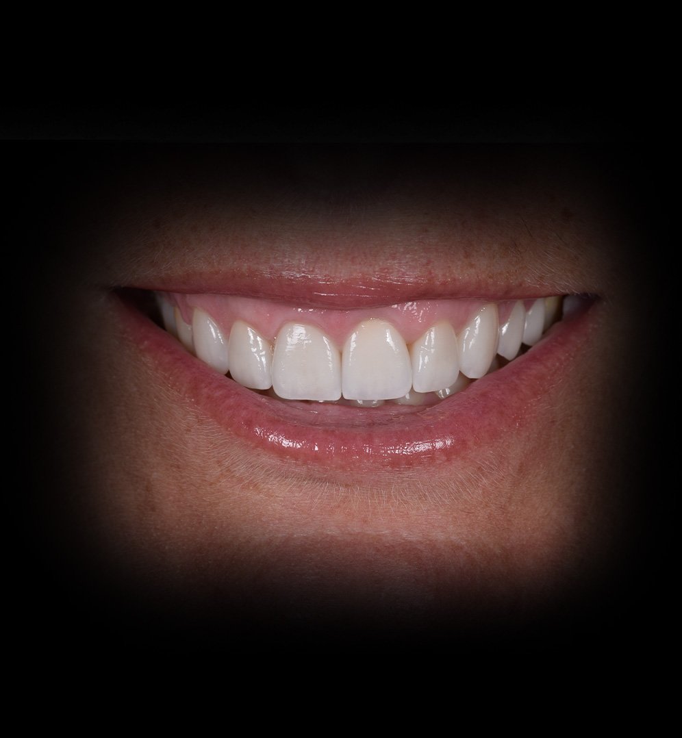 Brooke Smile Transformation Story