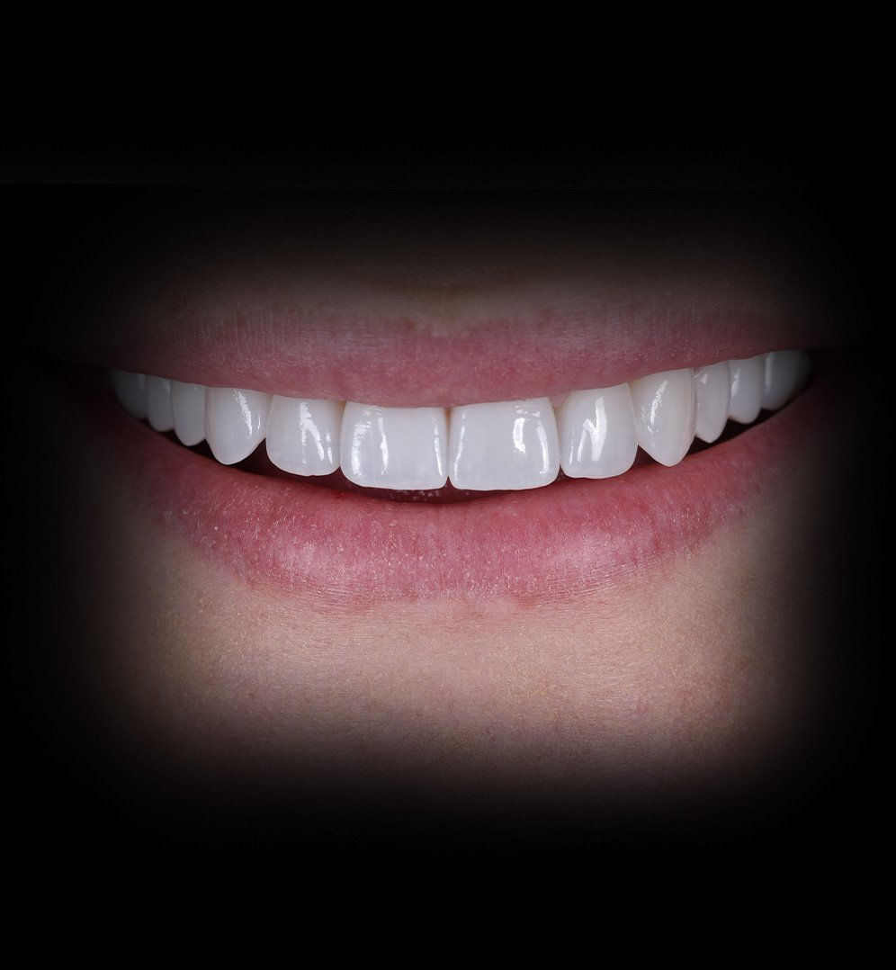 Celena Smile Transformation Story