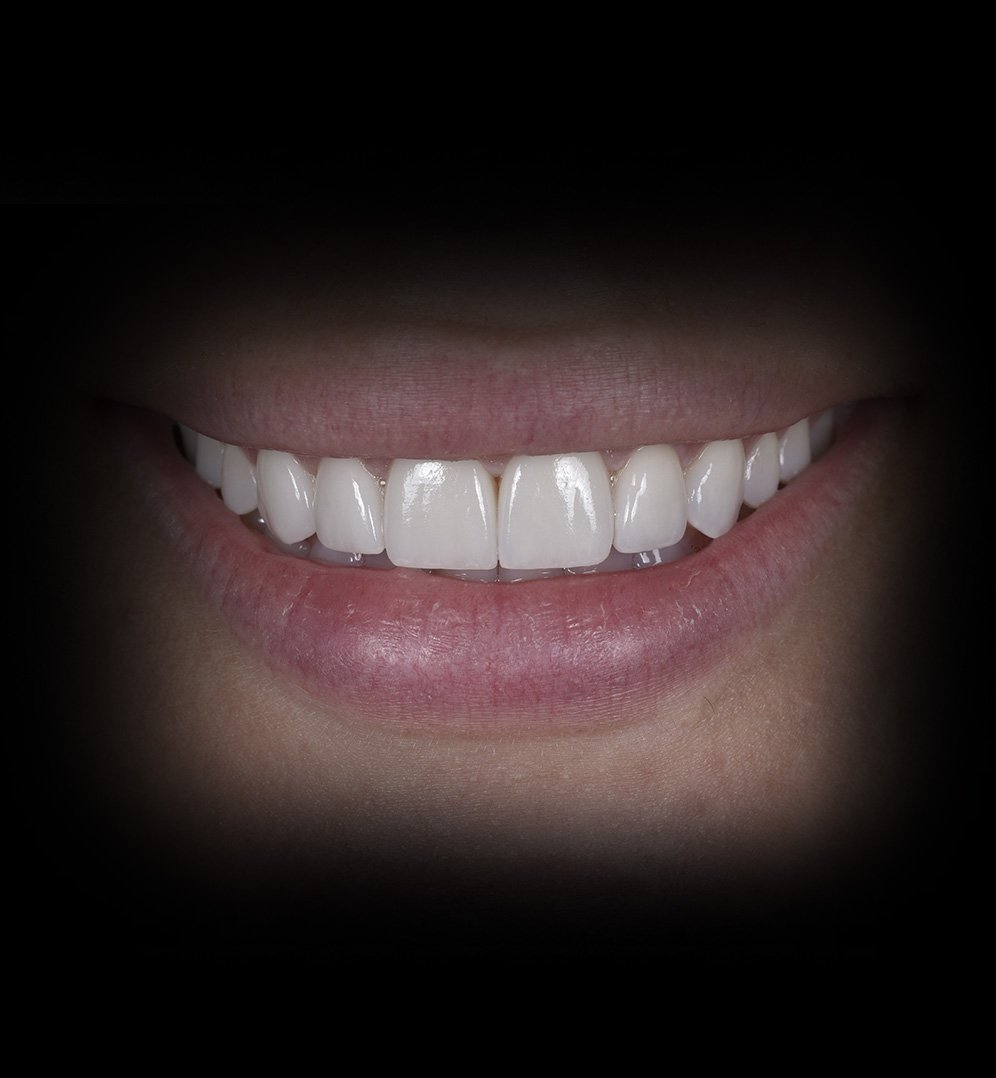 Ireni Smile Transformation Story