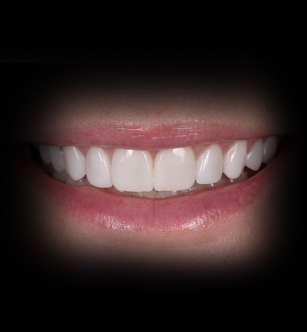 Johanna Smile Transformation Story