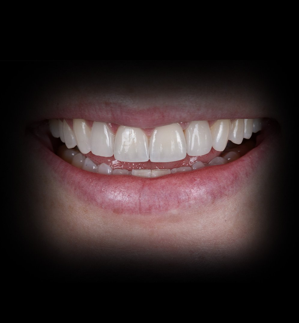 Katie Smile Transformation Story