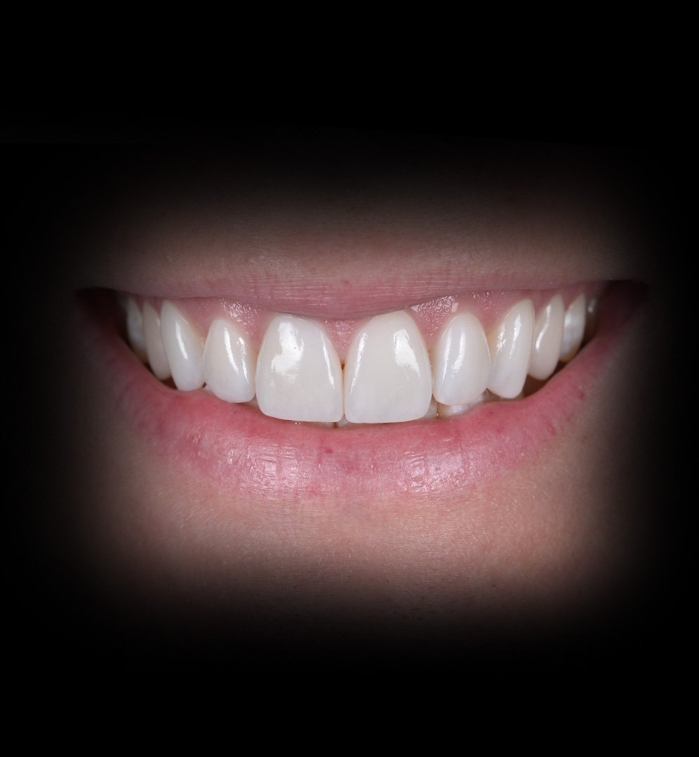 Kates Smile Transformation Story