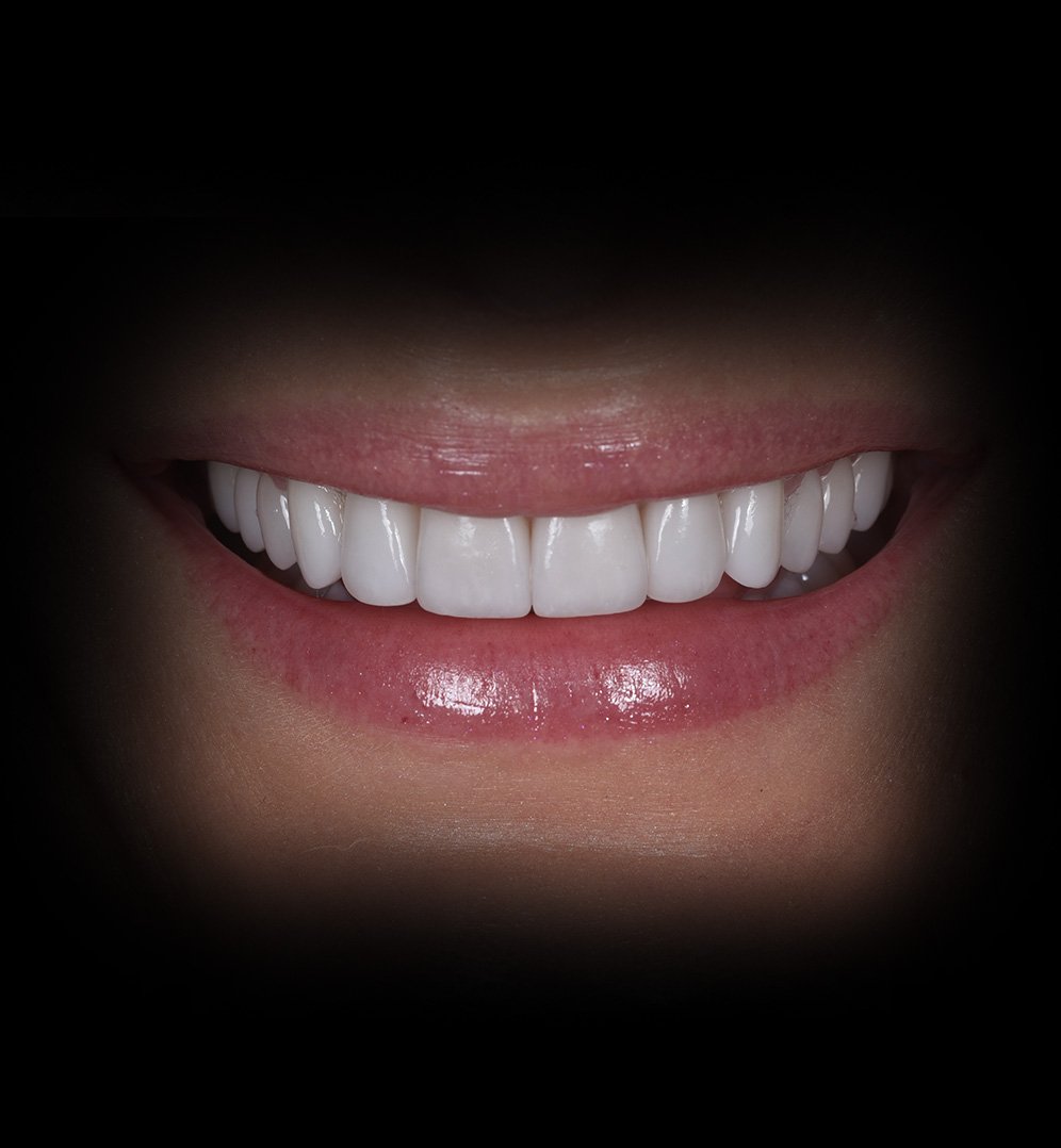 Laurens Smile Transformation Story