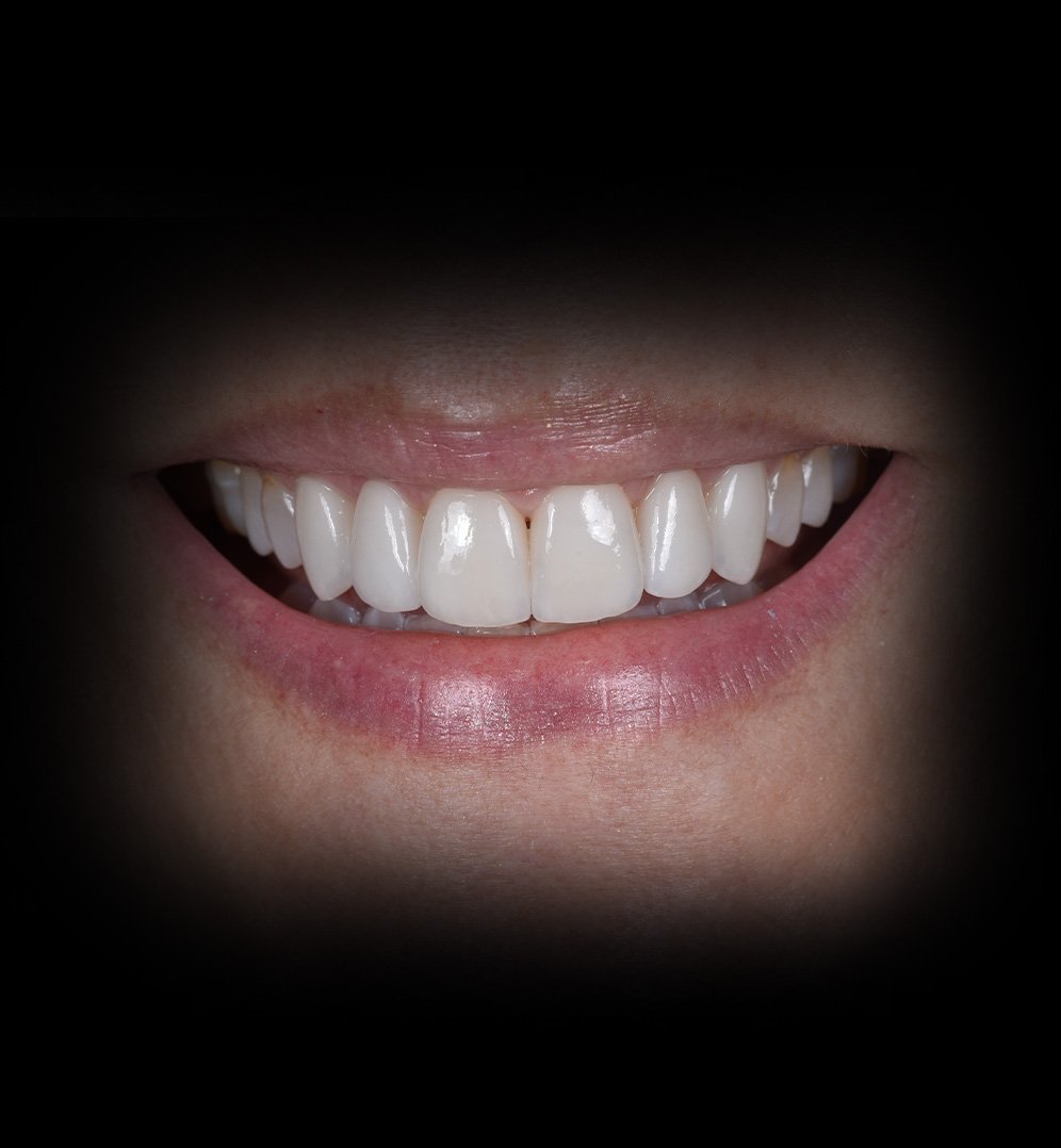 Lauren Smile Transformation Story