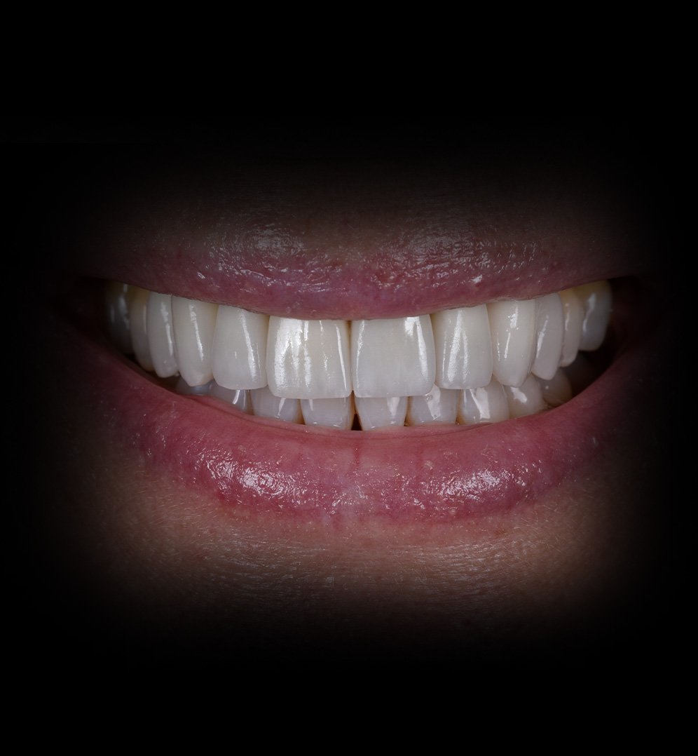 Lori Smile Transformation Story