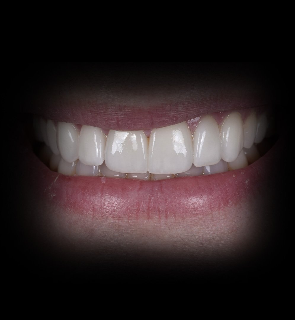 Melanie Smile Transformation Story