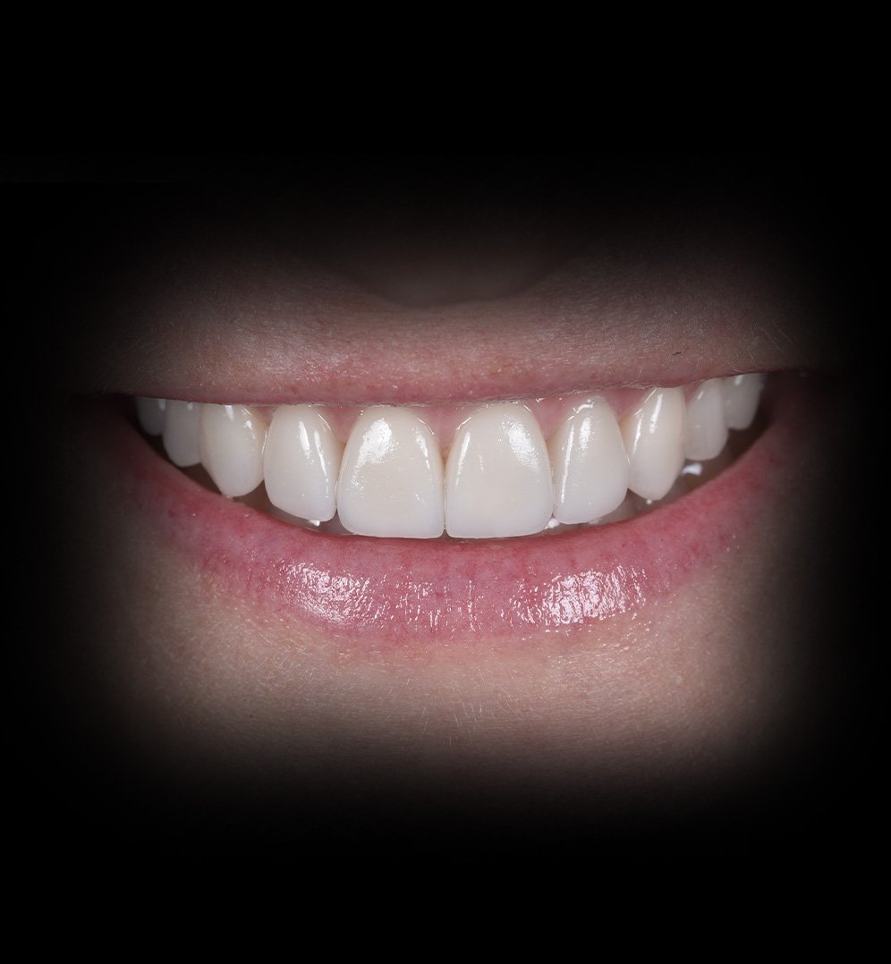 Nisse Smile Transformation Story