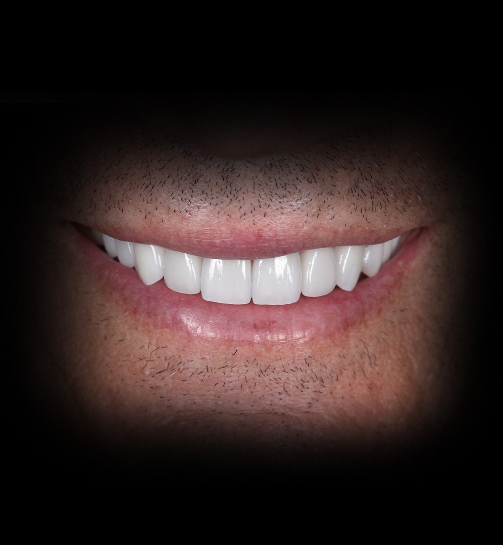 Steve Smile Transformation Story