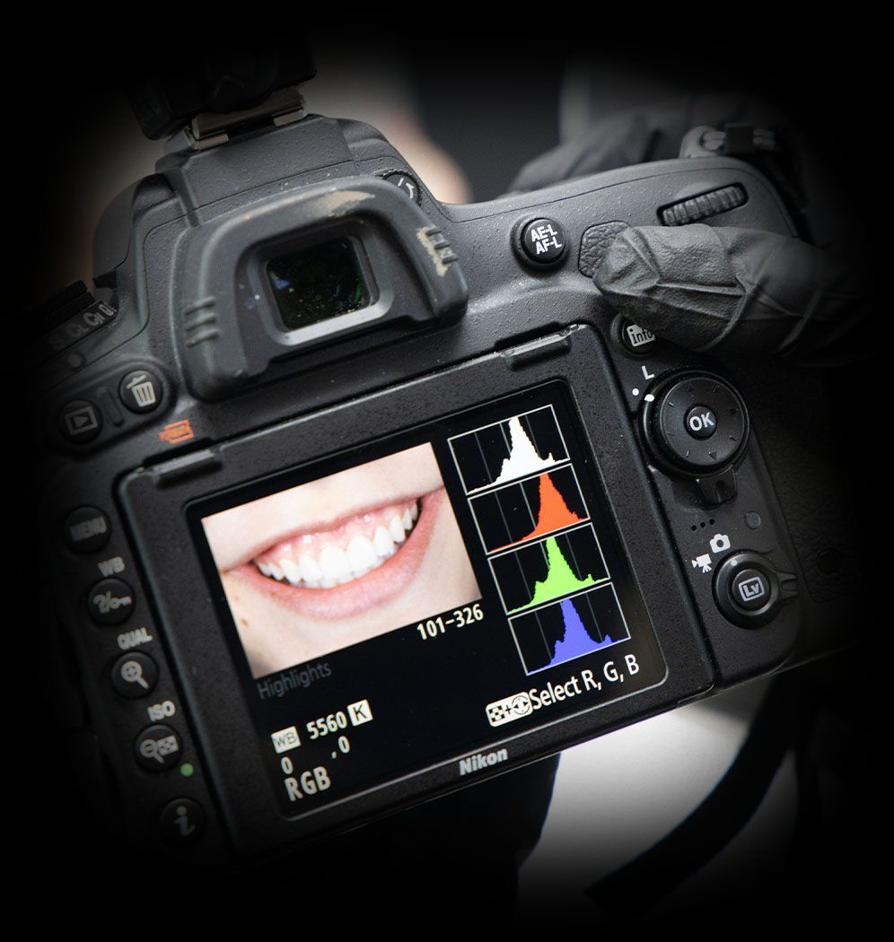 Dental Bonding Camera