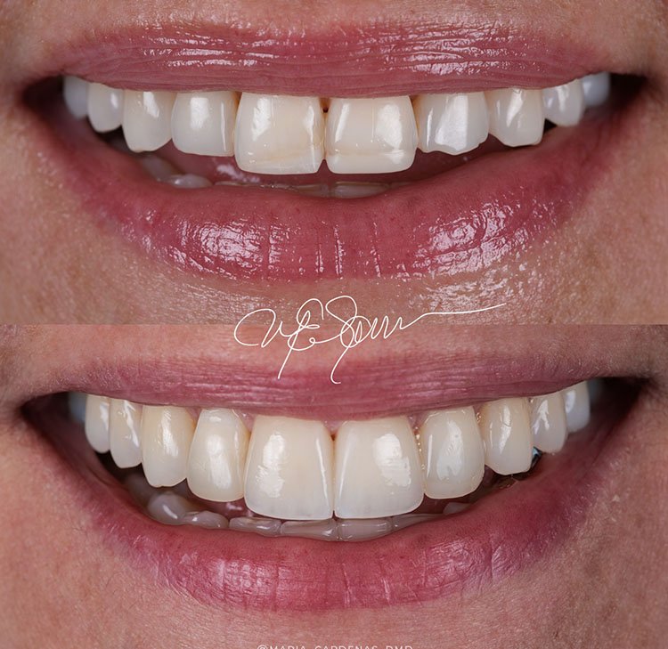 Dental Bonding Video