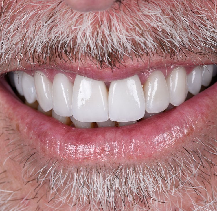 Steven Dental Crowns Video