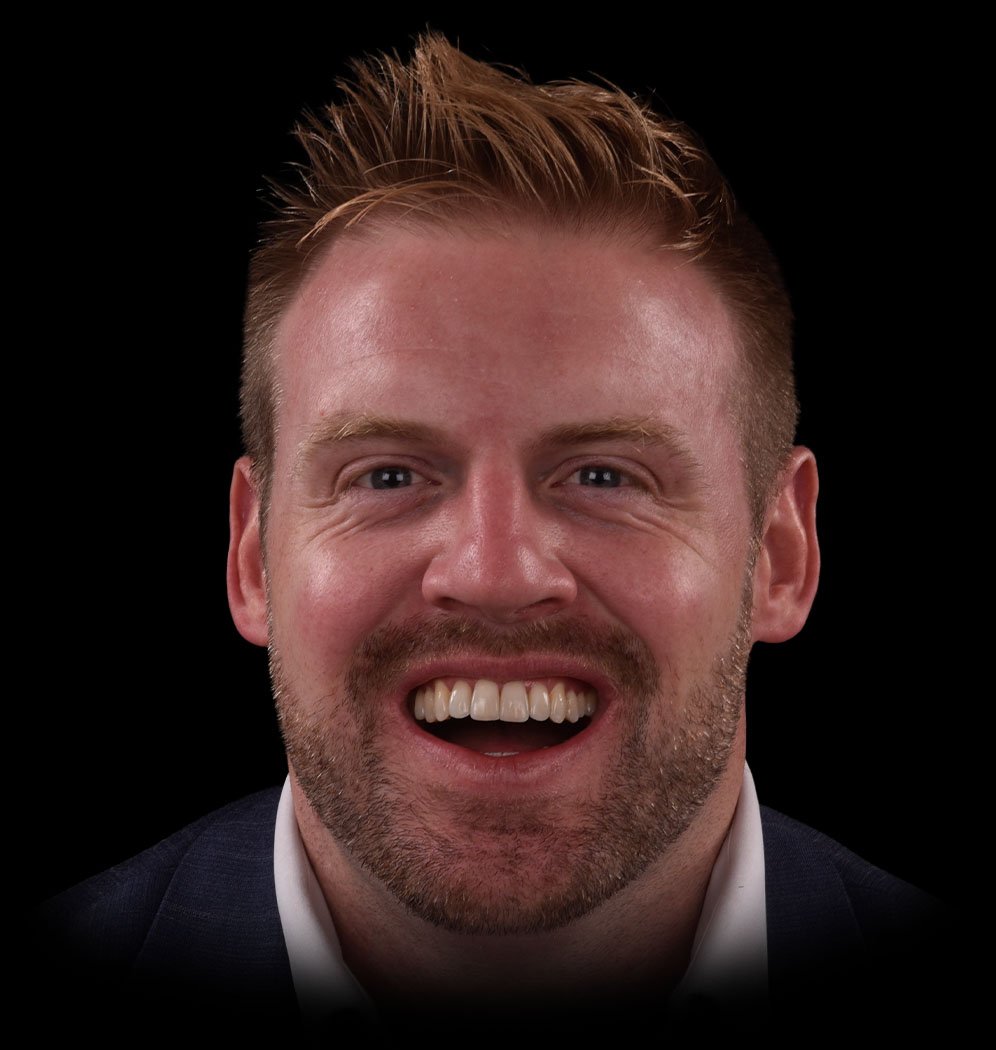 Thomas with Tooth Colored Fillings