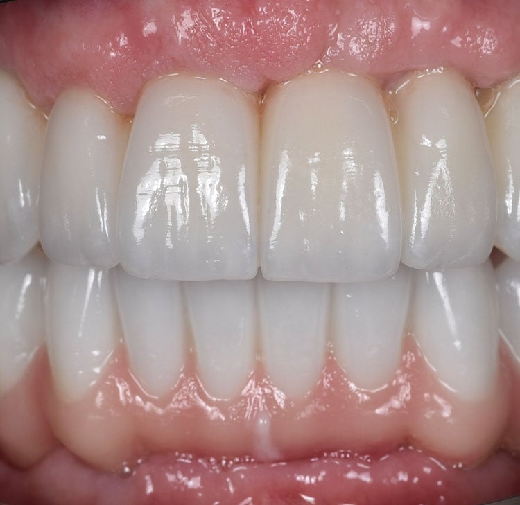 Dental Implant Restorations