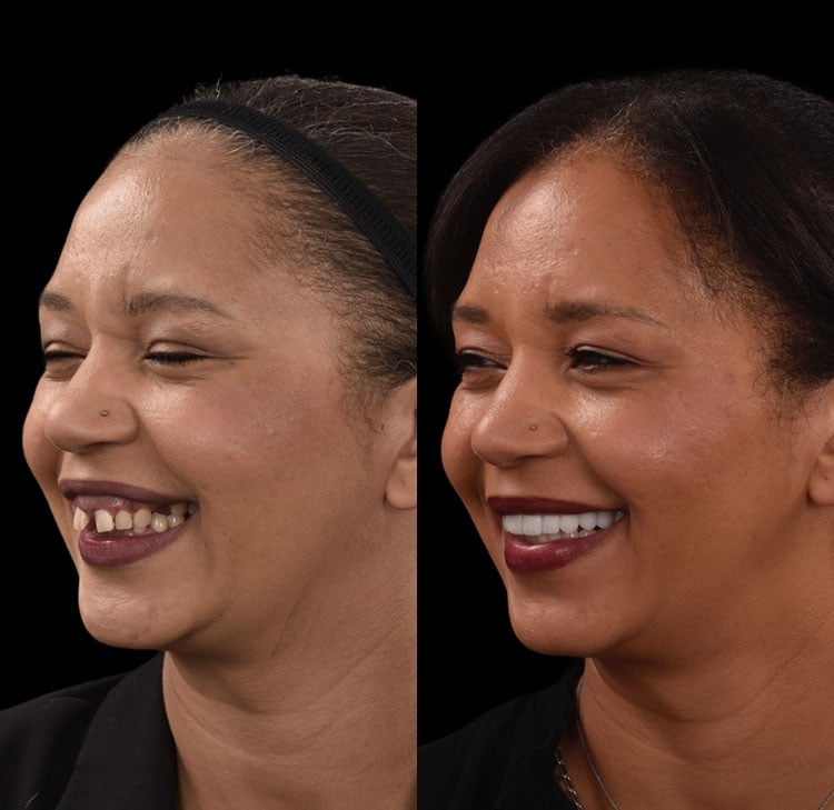 Jaw Replacement Before and After Video