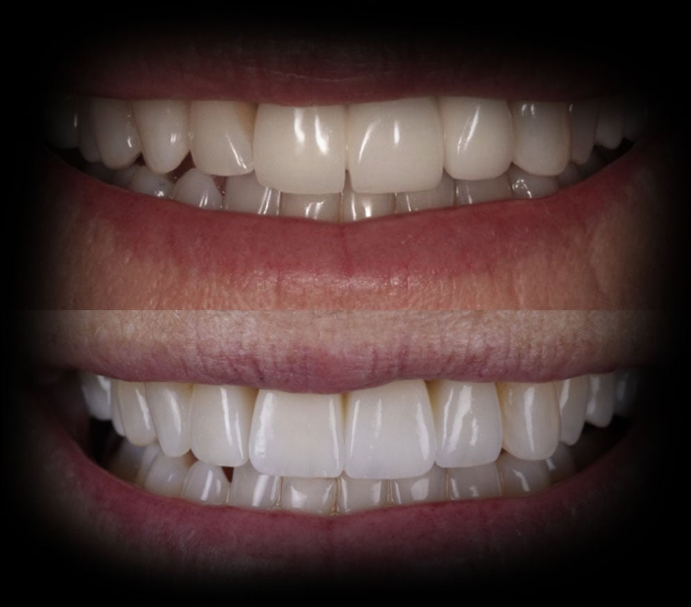 Porcelain Fixed Bridges Wellesley MA