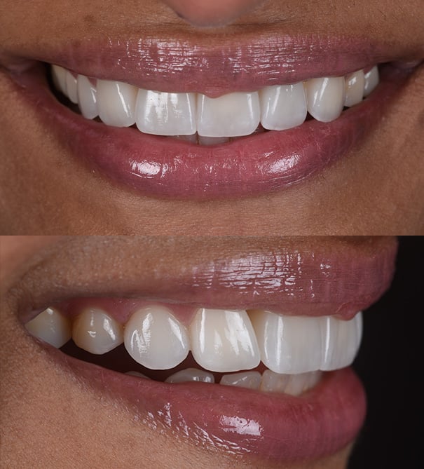 _Reasons for a fixed dental bridge 2.jpg_Porc_bridge4