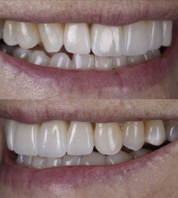 Types of Dental Bridges