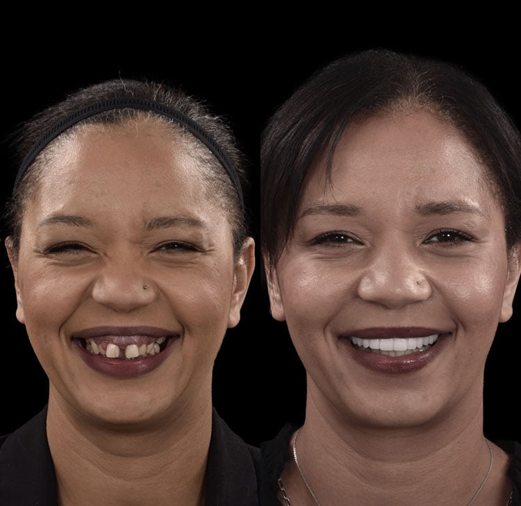 Happy Patient Tracy with Multiple Teeth Dental Implants Before and After