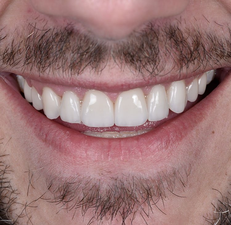 Restoring Smiles & Confidence With Expert Prosthodontic Care