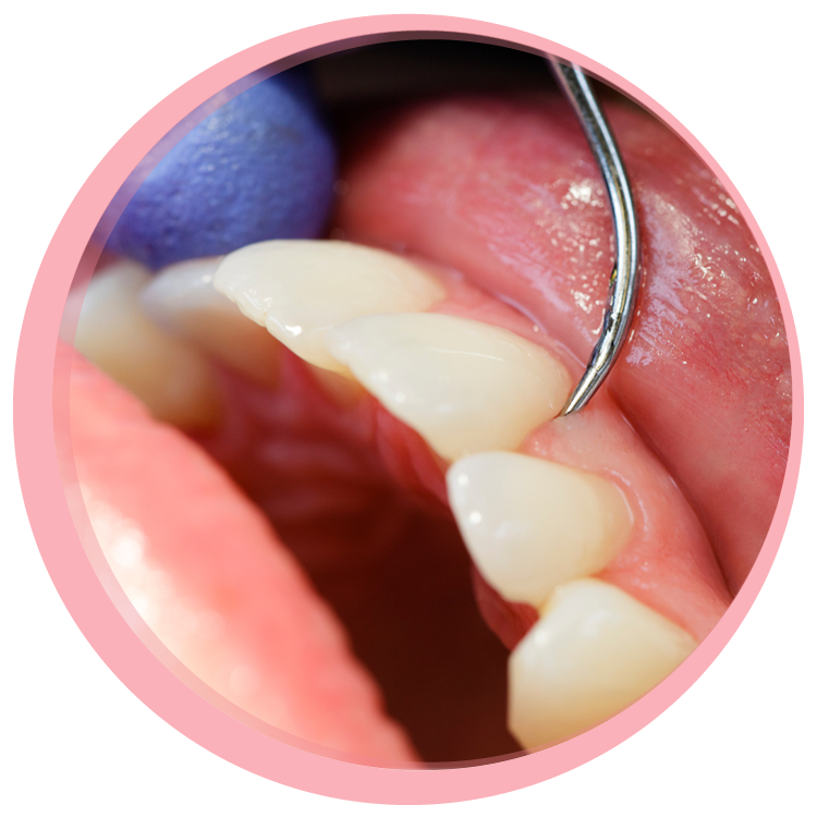close up of teeth with dental instrument checking gumline