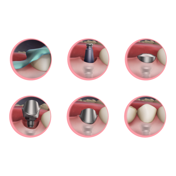 Dental implant Process at Maria Cardenas DMD