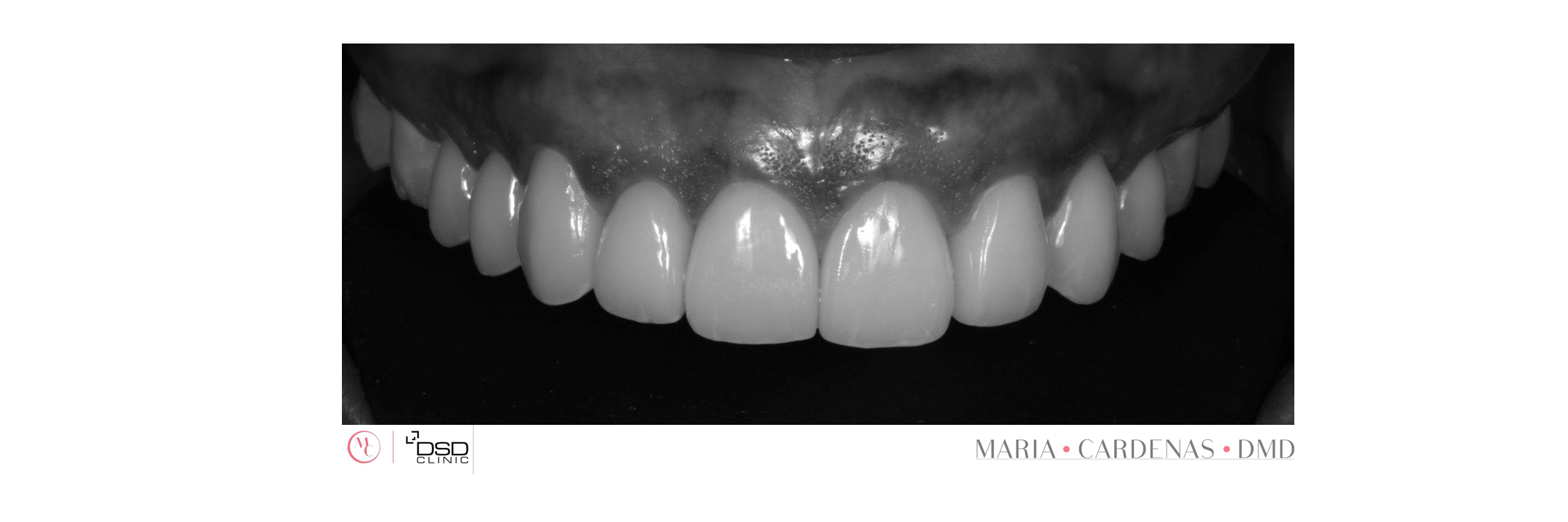 Dental Implant Smile 