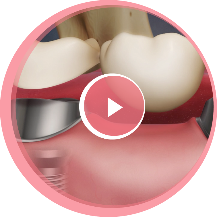 dental bridges