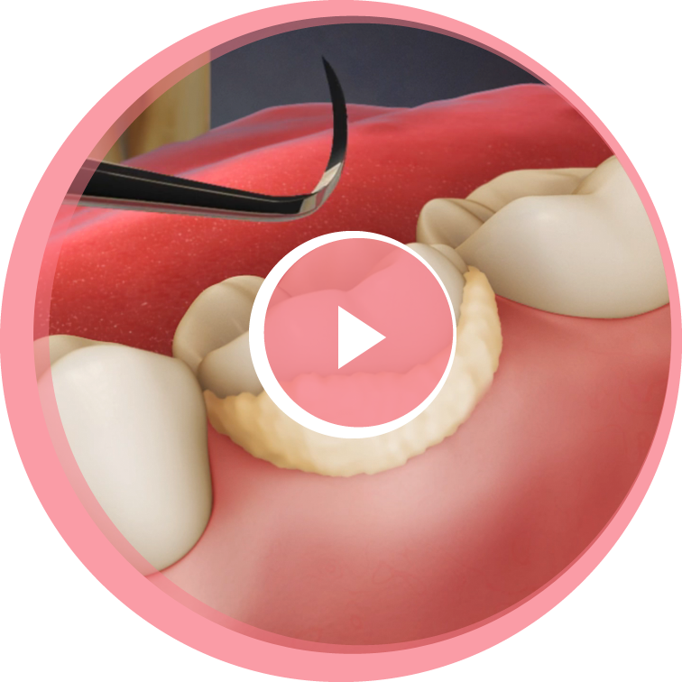 dental-cleaning