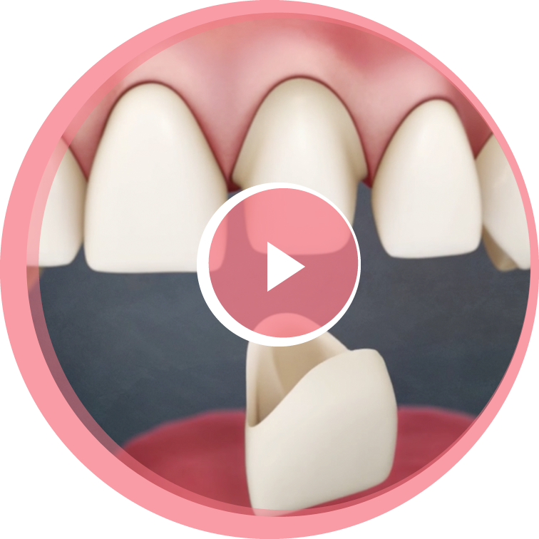 dental-crowns