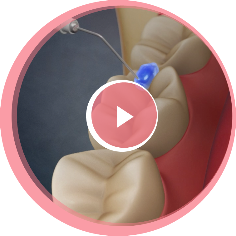 dental-sealants