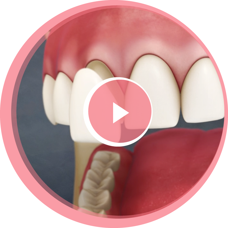 A close-up of a dental veneer being fitted over the top of an existing tooth.