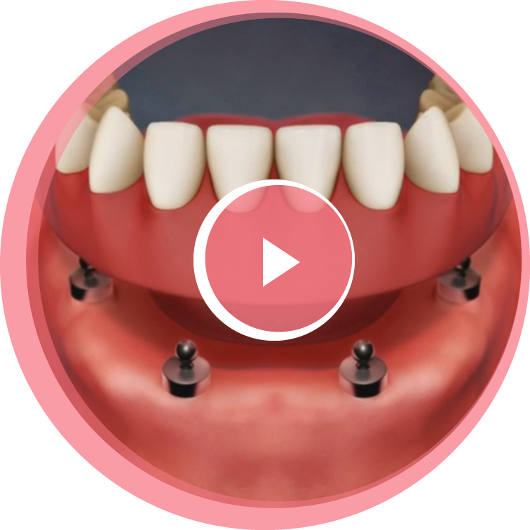 A full set of dentures being fitted onto the lower arch of a person's mouth.