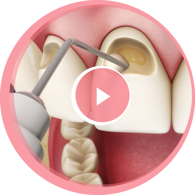 white-dental-filling