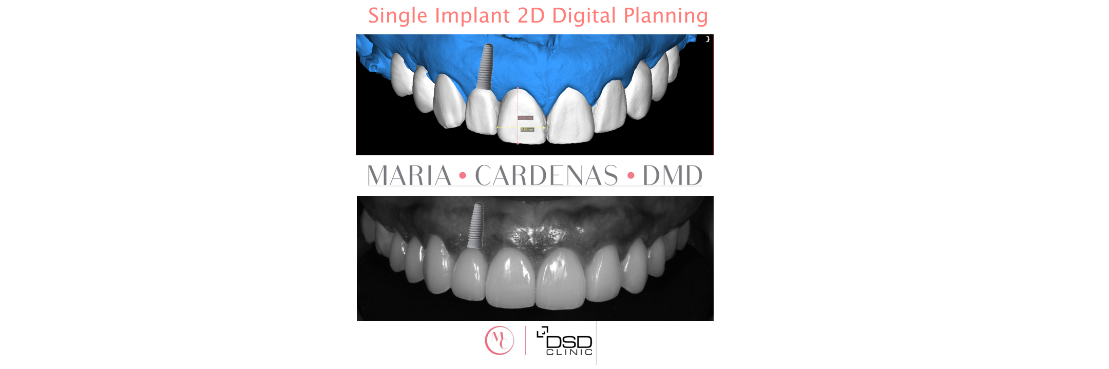 Single Dental Implant Digital Planning 